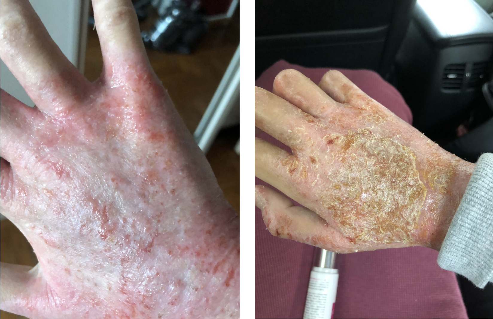 Understanding TSW Skin Flares: Decoding Your Healing Cycle